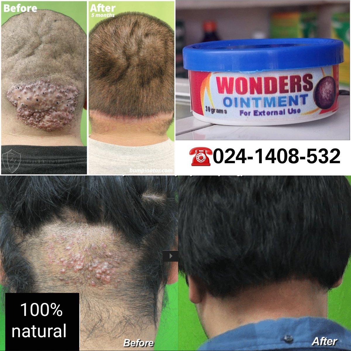 Get rid of stubborn razorbumps as soon as possible. 100%Results Guaranteed in a week. Let's talk we do delivery worldwide. #jodelherbal #health #viral #GH2023