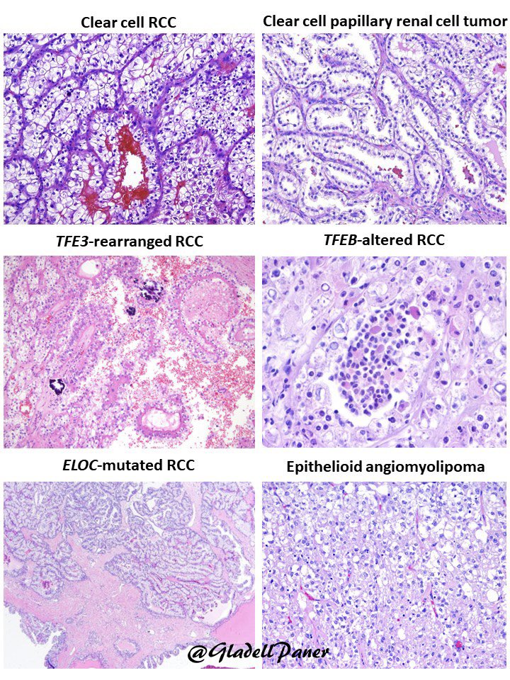 For our 2023 #pathology trainees, remember this #GUPath adage👇 “Not all renal tumors with clear cells are clear cell renal cell carcinoma” … spot on in this molecular era! 👇Below are DDX for Clear cell #RCC including #renal tumors with some degree of cytoplasmic clearing🔬