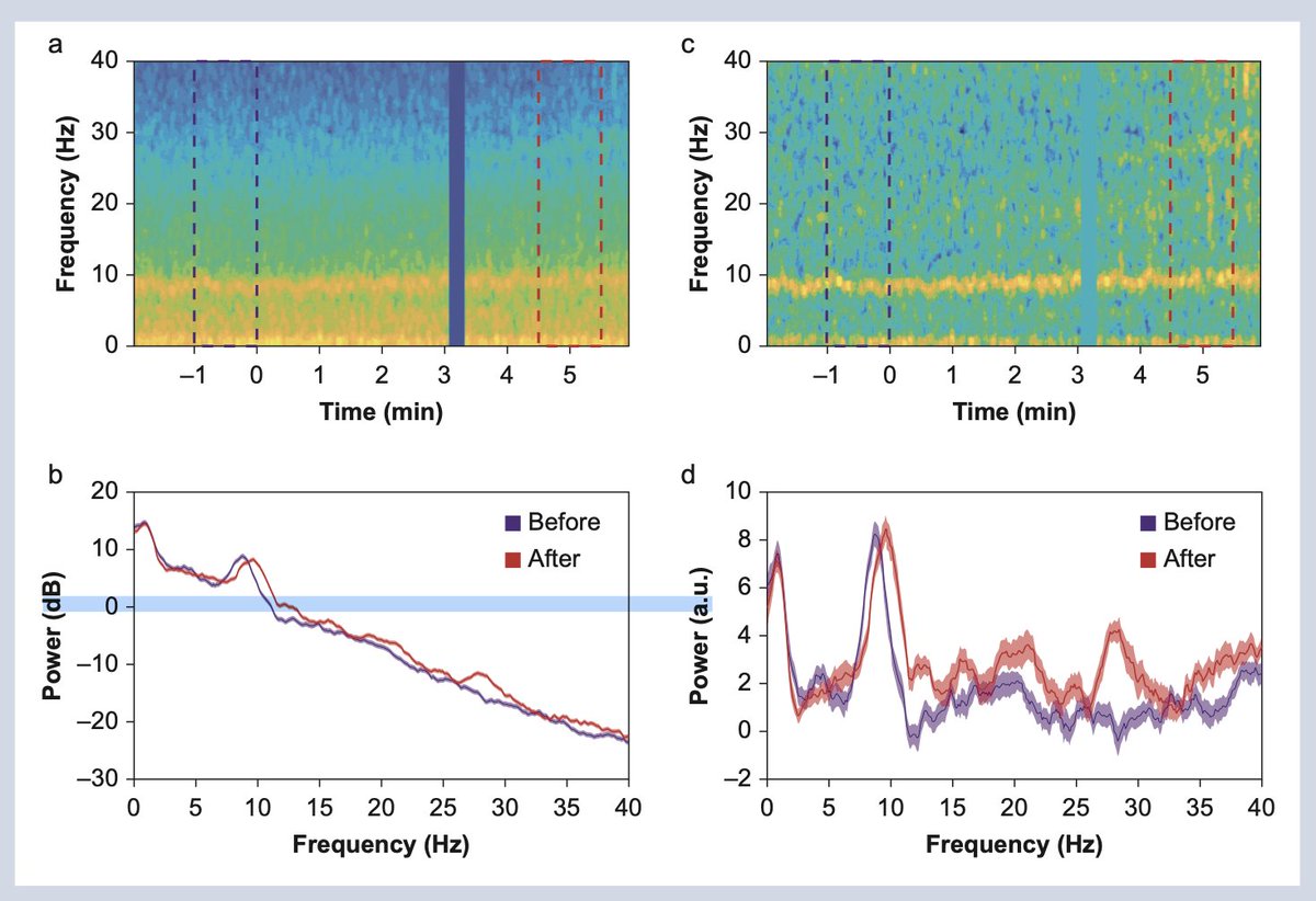BJAJournals's tweet image. 🔓Does sugammadex administration affect pEEG at constant levels of anaesthesia? New study from Rubio-Baines et al. offers insight #Anaesthesia #pEEG #DepthOfAnaesthesia #openaccess

bjanaesthesia.org/article/S0007-…