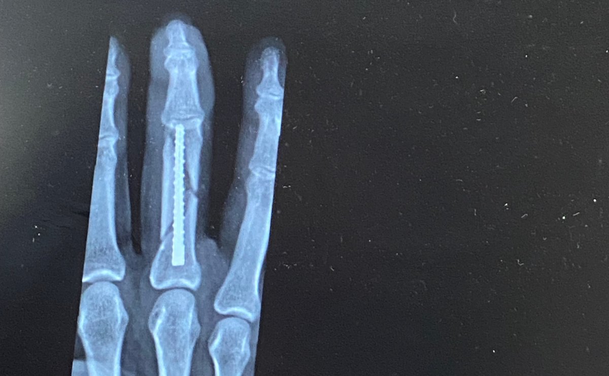 Healing Update! Had surgery after a bad finger break on June 20th. Now with a permanent screw! Physical Therapy's tough, but I'm pushing through. Today, held a guitar pick at band practice! Your support means the world! Onward to a stronger hand! #HealingJourney #RoadToRecovery
