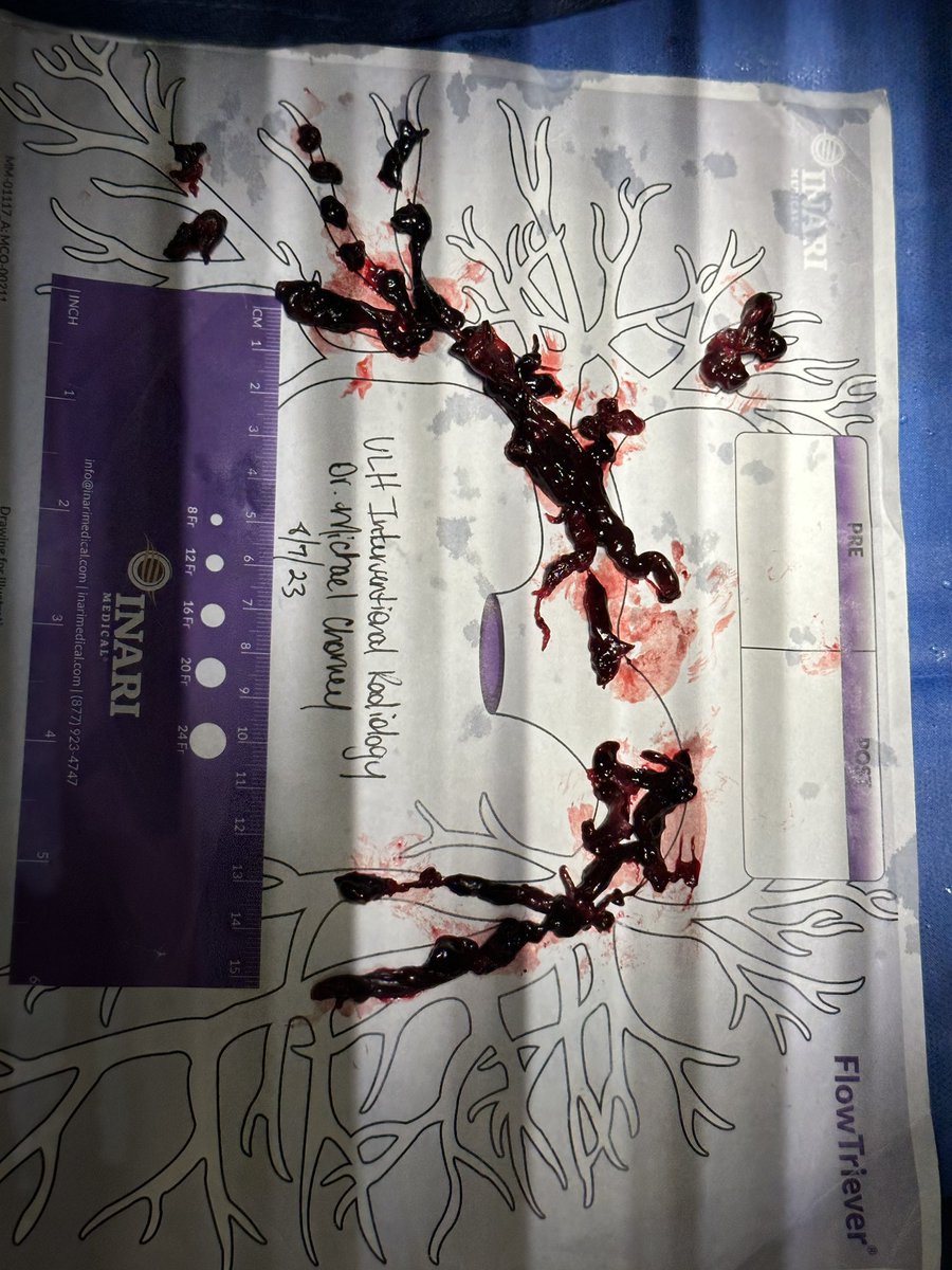 Bilateral PEs treated with mechanical thrombectomy! 20 point decrease in main PA pressure!

Another great case at <a href="/UofLRadiology/">Louisville Radiology</a> under the fantastic guidance of <a href="/ChorneyMD/">Michael Aaron Chorney, MD, MBA, RPVI</a> 

<a href="/LoucityI/">LouCity IR</a> <a href="/SIRRFS/">SIR RFS</a> #VIR