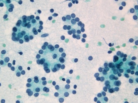 Differentiating between benign (BII) and follicular neoplasm (BIV) - spherules vs microfollicles #Thyroid FNA #PathTwitter #patologia #Cytology  pubmed.ncbi.nlm.nih.gov/31856389/