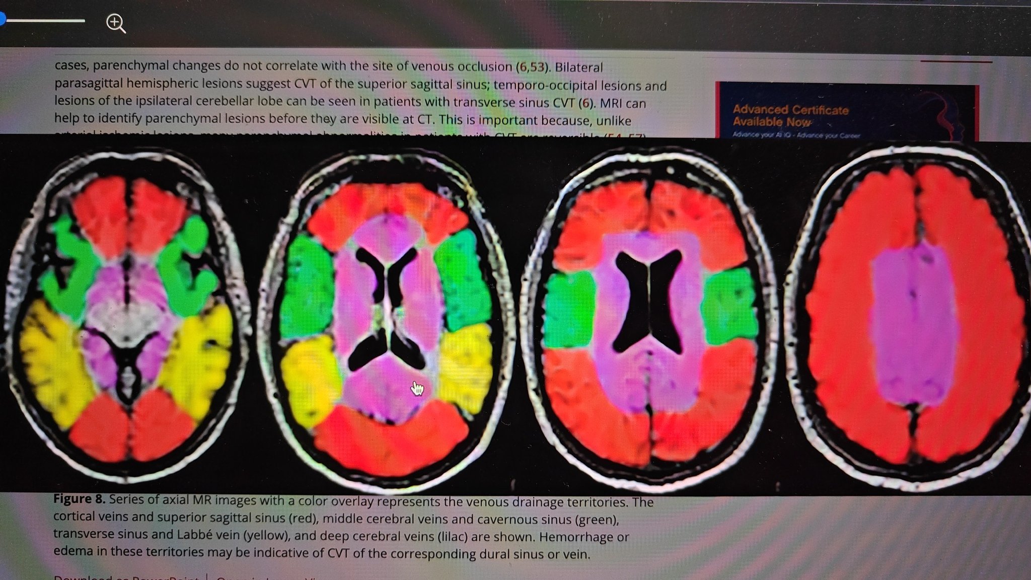 The larger superficial cerebral veins, including those draining the