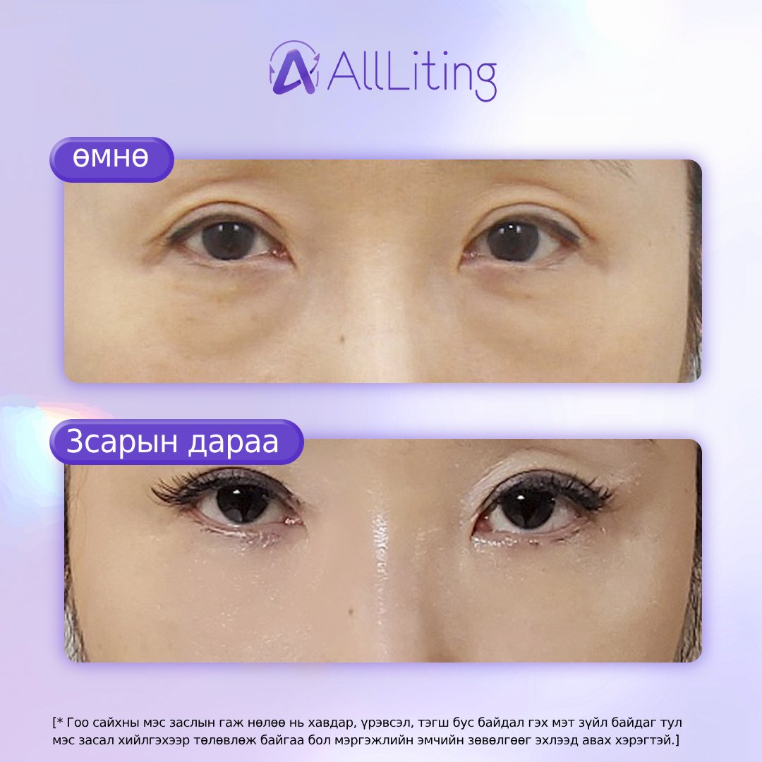 📷#ДООД_ЗОВХИ_УУТАНЦАР_АРИЛГАХ📷
📷доод зовхины уутанцар тараах ажилбар хийгдсэн
-------------------------
📷📷 ҮЗЛЭГ/ЗӨВЛӨГӨӨ үнэгүй хийж зөвхөн таньд тохирсон мэс заслын төлөвлөгөөг гаргана.
📷монгол ажилтан: 010-4931-4451