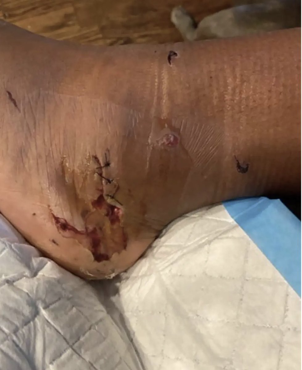HarrietEve9's tweet photo. TMZ broke the story of Megan Thee Stallion injured foot being from broken glass — and Tory Lanez arrest for a unregistered gun…

TMZ release the the entire footage of the incident…

A few days later — Megan went to her IG account to announce that her injury was not from glass — but was actually from being shot with gun…

At or about a month later — Megan went on IG live to accused Tory Lanez as being the shooter.. 

I immediately went back to look at TMZ video footage of Megan standing and walking in the video.., Yes, she was injured — but in my opinion — she didn’t look like someone who had been shot in both feet at point blank range — BAREFOOT…

Months later, the reports and transcripts start coming out… 

The initial ER physician says her injuries are superficial — however, twelve hours later — a orthopedic surgeon says she has been shot in boot feet…

Due to the fact that the surgical report states that 12 hours after Megan entered Cedars Sinai ER — she went under general anesthesia to remove bullet fragments from BOTH her foot…

However, there is no evidence of the bullet fragments by the LAPD — and Cedars Sinai orthopedic surgeon Dr. Little only provided the LA prosecutors office with one blurry photo of her left foot.. 

Interestingly, Megan posted to her IG account one photo of her left foot… 

We can agree to disagree — but answer two questions:

1. When has a patient ever been admitted to a hospital for superficial wounds???

2. When has there not been before & after clear photos of a high profile patient with GSW’s and fragments removed — for a planned scheduled surgical procedure??? Any healthcare professional who has worked with a orthopedic surgeon before knows what it is — please don’t answer the question…