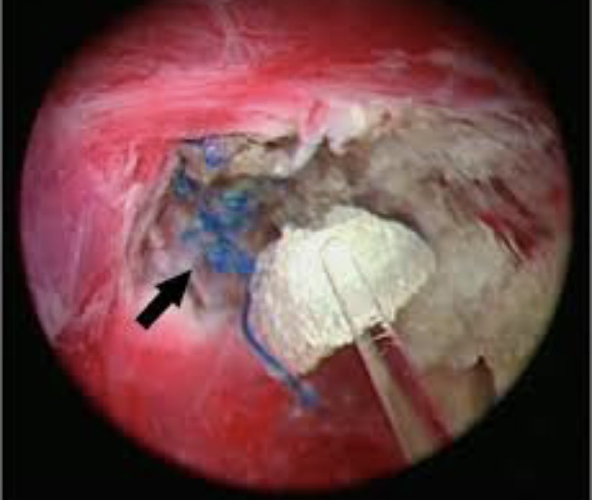 true extent of internal damage caused by #mesh still not out in the open

mesh sticking to internal organs was NEVER consented to occur 

this is extremely serious &amp; catastrophic harm 

Left living in agony &amp; declining health 

<a href="/PSCommissioner/">Patient Safety Commissioner</a> <a href="/mariacaulfield/">Maria Caulfield CBE</a> #nojustice