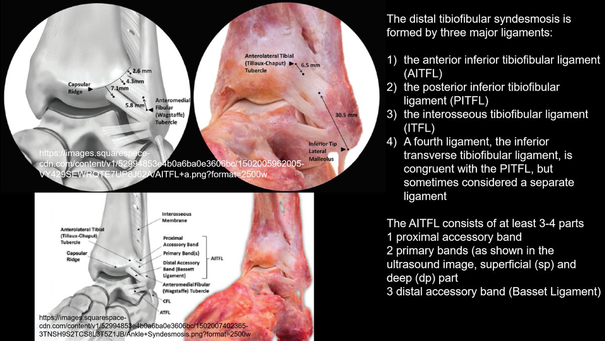 Rheumatology's tweet photo. AITFL

https://t.co/4ZXKDiAUdS

The AITFL consists of at least 3-4 parts
1 proximal accessory band
2 primary bands (as shown in the ultrasound image, superficial (sp) and deep (dp) part
3 distal accessory band (Basset Ligament) https://t.co/zdaRcPV5oG