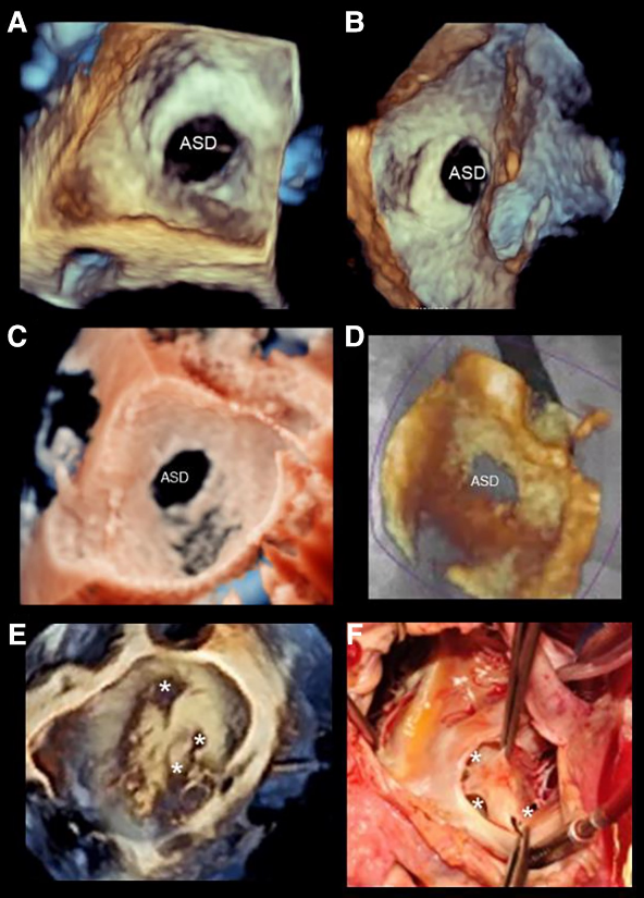 Victoria Delgado (@vdelgadogarcia) on Twitter photo The guide you were looking for on 3D TOE: how to use and when to use—a clinical consensus statement from the EACVI <a href="/EACVIPresident/">EACVI President</a> <a href="/NuriaVallejo4/">Nuria Vallejo</a> <a href="/NAjmoneMarsan/">Nina Ajmone Marsan</a> <a href="/hahn_rt/">RTHahnMD</a> <a href="/denisamuraru/">Denisa Muraru</a> <a href="/AnnaGiuliaPavon/">Anna Giulia Pavon</a> <a href="/SONECOM_AC/">SONECOM</a> <a href="/ASE360/">American Society of Echocardiography</a> <a href="/VazyurVasquez/">Zuilma Vásquez</a> <a href="/ImagenCardiaca/">SEIC - Sociedad Española de Imagen Cardíaca</a> academic.oup.com/ehjcimaging/ar… The guide you were looking for on 3D TOE: how to use and when to use—a clinical consensus statement from the EACVI <a href="/EACVIPresident/">EACVI President</a> <a href="/NuriaVallejo4/">Nuria Vallejo</a> <a href="/NAjmoneMarsan/">Nina Ajmone Marsan</a> <a href="/hahn_rt/">RTHahnMD</a> <a href="/denisamuraru/">Denisa Muraru</a> <a href="/AnnaGiuliaPavon/">Anna Giulia Pavon</a> <a href="/SONECOM_AC/">SONECOM</a> <a href="/ASE360/">American Society of Echocardiography</a> <a href="/VazyurVasquez/">Zuilma Vásquez</a> <a href="/ImagenCardiaca/">SEIC - Sociedad Española de Imagen Cardíaca</a> academic.oup.com/ehjcimaging/ar…