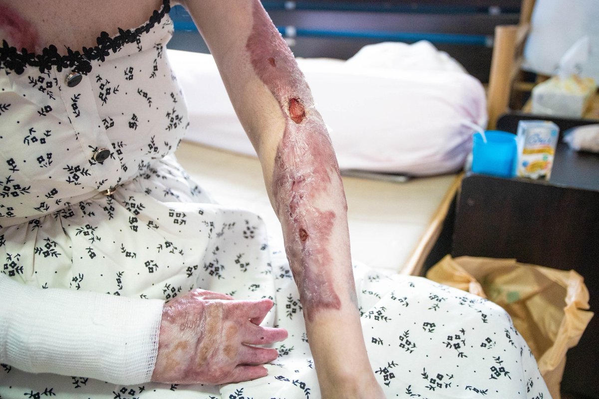 The_PattayaNews's tweet photo. One year after the tragic Mountain B nightclub fire in #Sattahip that killed dozens of people, the only foreigner present, who survived, a young Vietnamese woman, struggles to deal with her injuries and financial debt.
https://t.co/fvuXWNPfXe https://t.co/FAPMdmGCFE