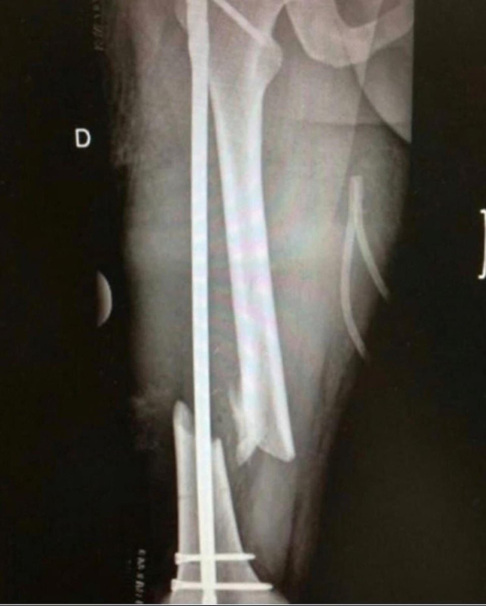 DrAJ26001405's tweet photo. At least the side view looked good #orthotwitter https://t.co/LazQ6aDAxE