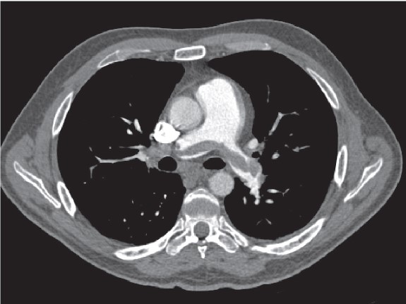 EMNews's tweet photo. Beware the painless #PE, says @EM1MinuteGuru because they’re usually larger and more severe than painful #pulmonary #emboli.
Read why: https://t.co/Ld6B0q5lTE. #FOAMed https://t.co/DNR2pM3fnZ