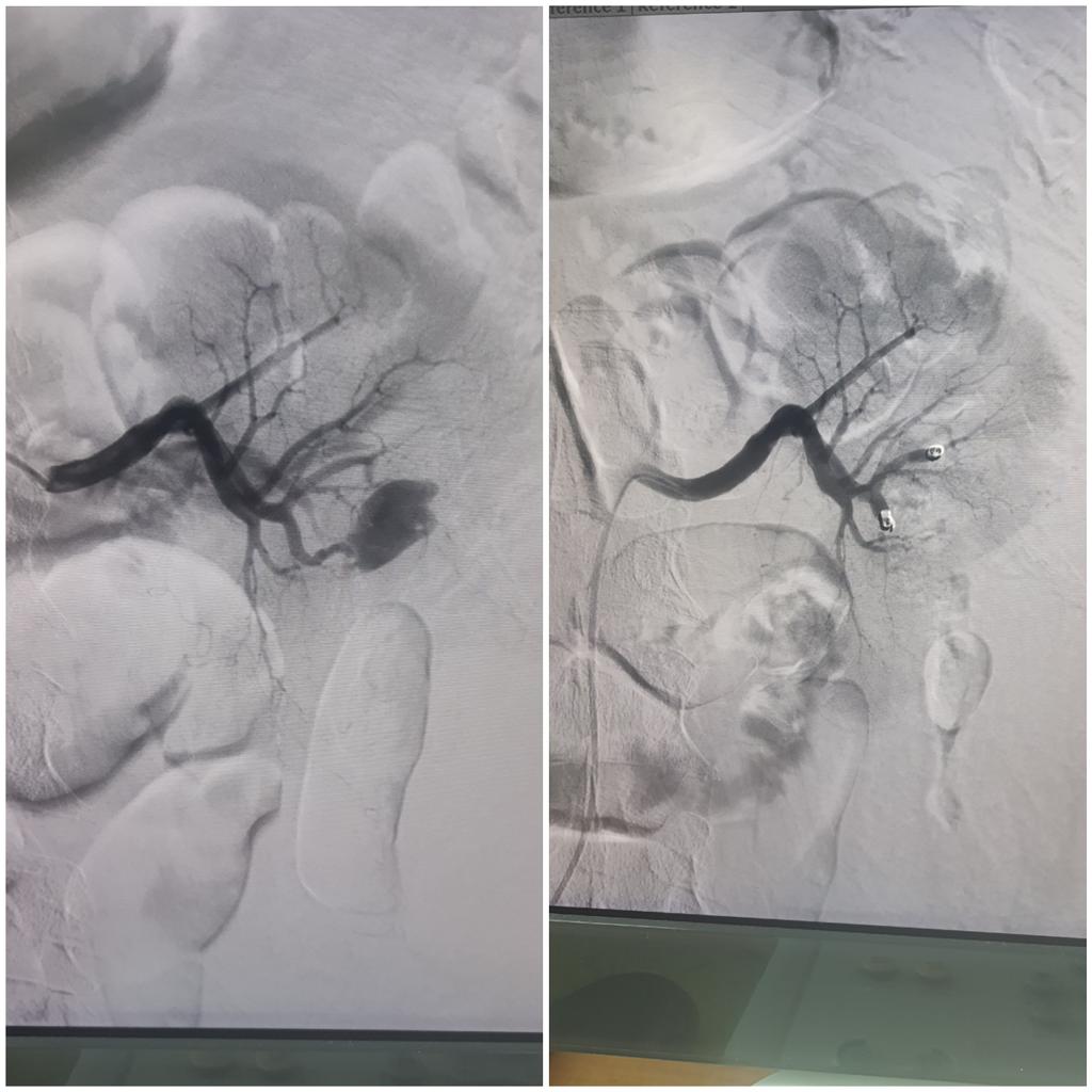 Dr Saurabh kumar Interventional radiologist tweet media