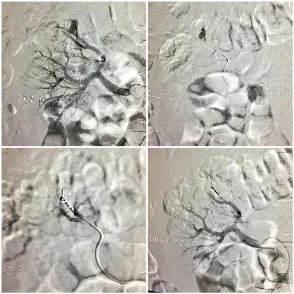 Dr Saurabh kumar Interventional radiologist tweet media