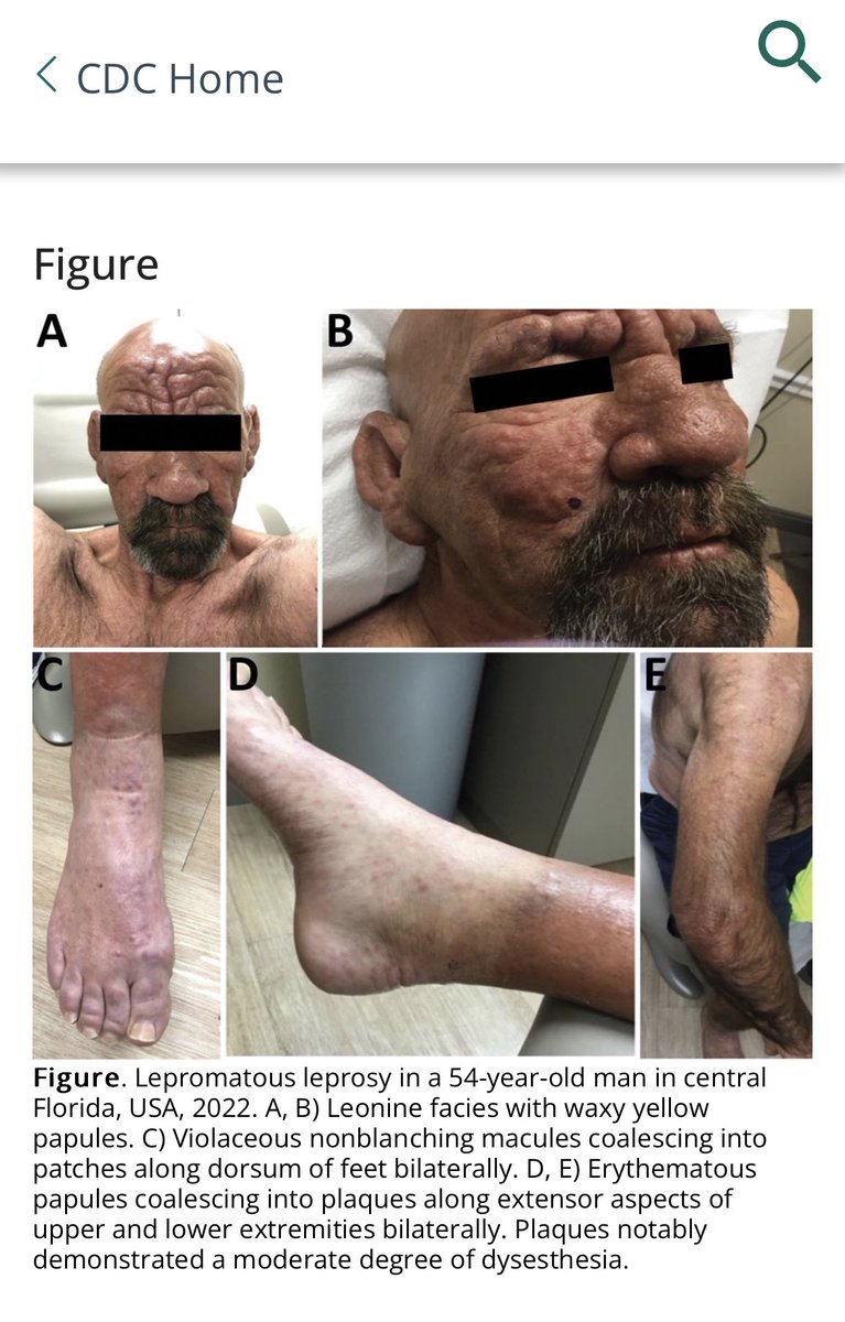 DrEricDing's tweet image. It’s weird that leprosy is increasing, esp in Central Florida, which the CDC say account for 81% of reported cases in the state and almost one-fifth of all cases nationwide, with 34% of #leprosy locally acquired transmission. CDC says “leprosy has become endemic” in SE. Several…
