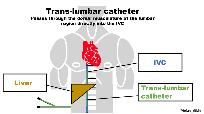 edgarvlermamd's tweet image. Unconventional Sites for Hemodialysis Arteriovenous Access Creation and Catheter Placement from @RenalFellowNtwk @ASDINNews @AhsanSohailMD 
#Nephpearls #VascularAccessPearls

Illustrations 🎨 by @brian_rifkin

👉 renalfellow.org/2023/08/06/164…