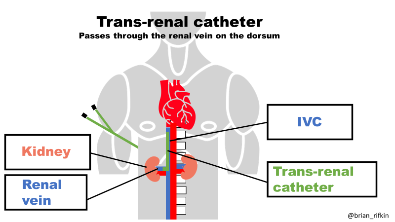 edgarvlermamd's tweet image. Unconventional Sites for Hemodialysis Arteriovenous Access Creation and Catheter Placement from @RenalFellowNtwk @ASDINNews @AhsanSohailMD 
#Nephpearls #VascularAccessPearls

Illustrations 🎨 by @brian_rifkin

👉 renalfellow.org/2023/08/06/164…