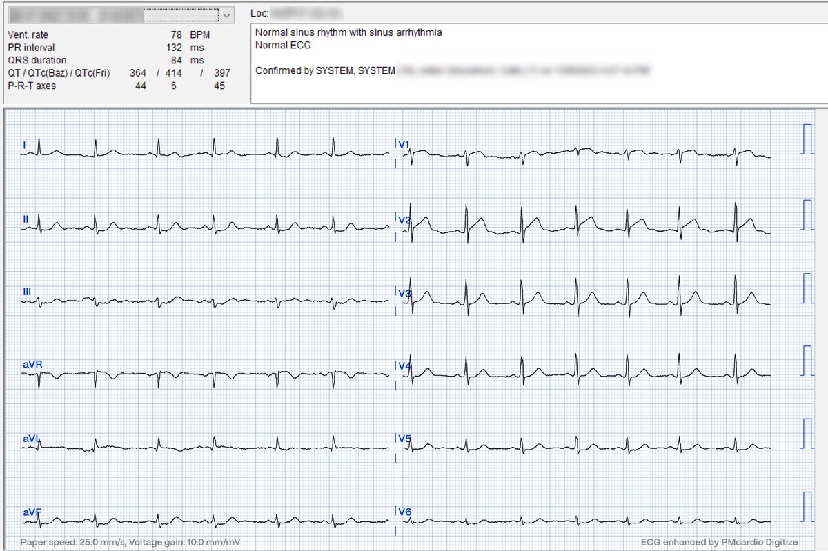 RobertHermanMD's tweet photo. Another reminder of why we need to change how we triage ACS patients! 

48yo male presents with chest pain and a minimally elevated hs-cTnT of 24.9 ng/L. Is his #ECG diagnostic?

(Original Marquette 12SL interpretation— ECG quality enhanced by @PMcardioBot)

#FOAMed #MedTwitter https://t.co/SgqvCqloTs