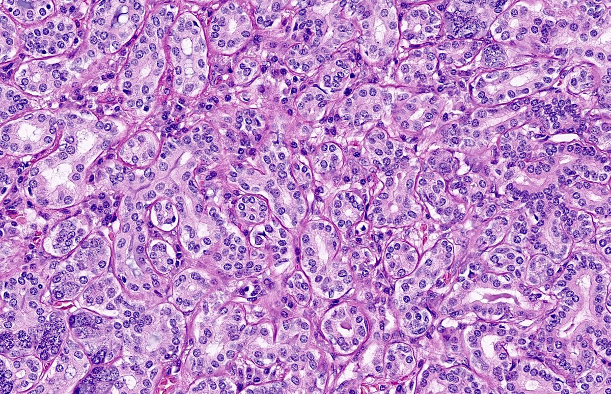 Incidental finding. 

#pathology #headandneck #PathTwitter #ENT #ENT_Pathology #headandneckpathology