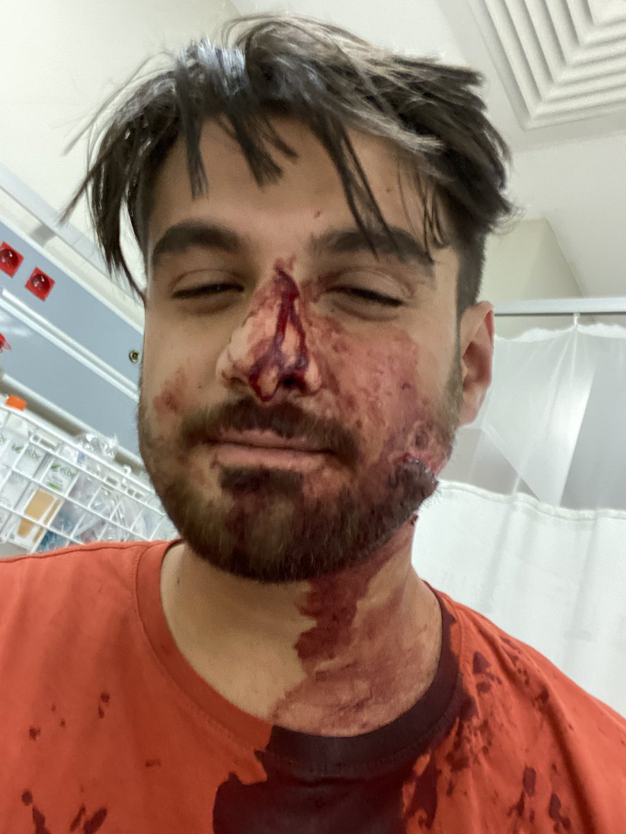 whisperhaber's tweet photo. Gaziantep'te bir grup Suriyeli tarafından bıçaklanan Mustafa Aydaş:

“Arkadaşlar, Ben bunun hesabını kime soracağım? Benim akan kanımın hesabını kim verecek? Annemin göz yaşlarının, babamın kahroluşunun hesabını kim verecek.

Madem ki eli bıçak, silah tutan bireyler var neden kendi ülkelerinde değiller? 

Arkadaşlar,ben sadece kardeşimi korumak istedim. Kötü bir şey yapmadım. Sonucu ise bu oldu. Kafamda 6,yüzümde 48 adet dikiş. Daha da söyleyecek bir cümlem yok. 

Şunu da eklemekte fayda var. Olayın failleri hala bulunamadı…”
