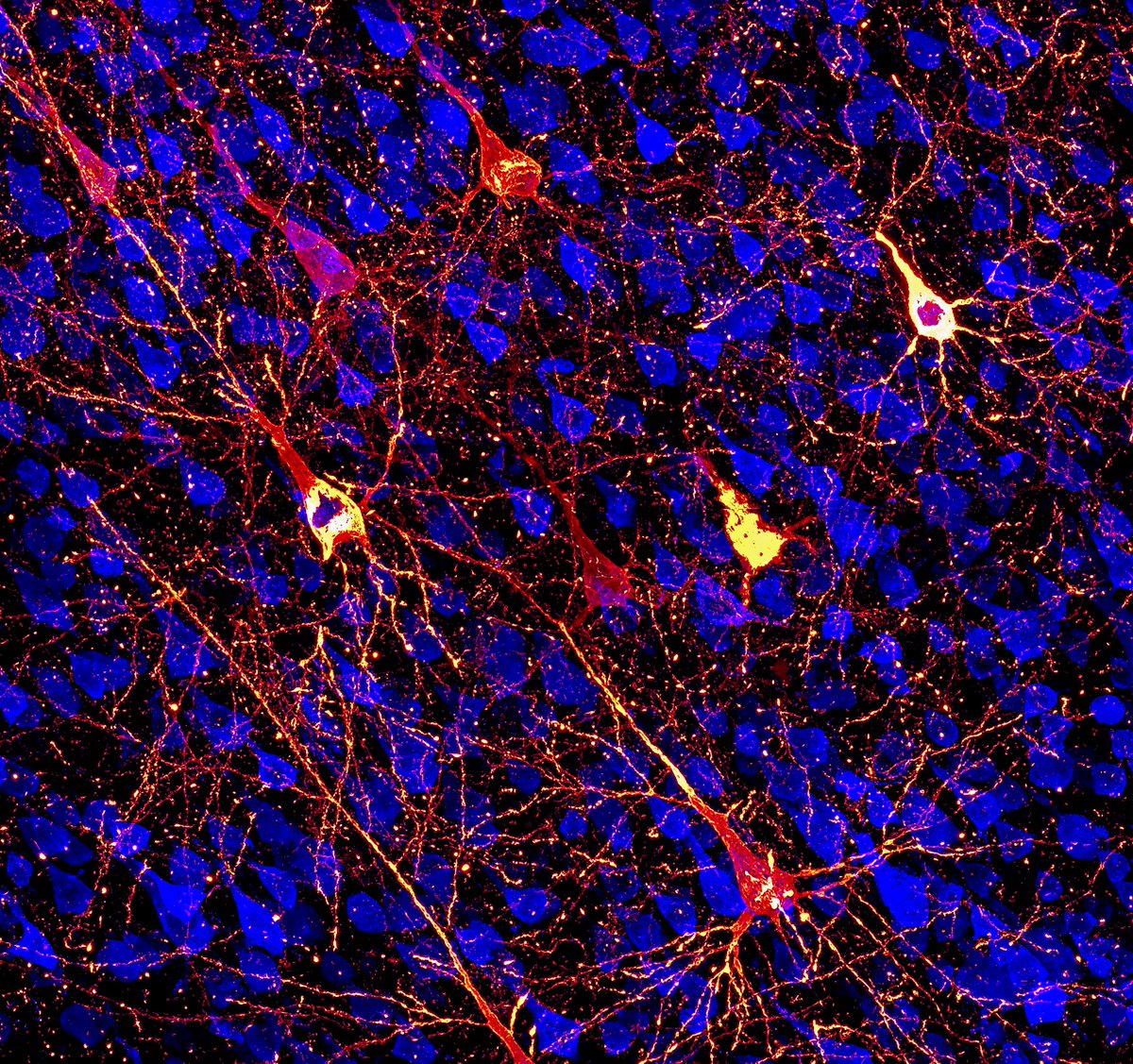 #Alzheimers: Neurons accumulating misfolded tau in the temporal sulcus in a monkey model. By combining an earlier marker for pathology (🟡AT8) with a late one (🔴ThioS), you can see neurons in different stages of cell death, like below! Healthy neurons in🔵(NeuN) #neuroscience