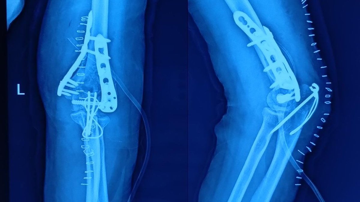 saur_sharma's tweet photo. @northwoods1980 For me, Tension band wiring is sufficient for olecranon osteotomy fixation. I haven't  faced any problem, especially non union or implant failure like this. https://t.co/QK6ccKC8GB
