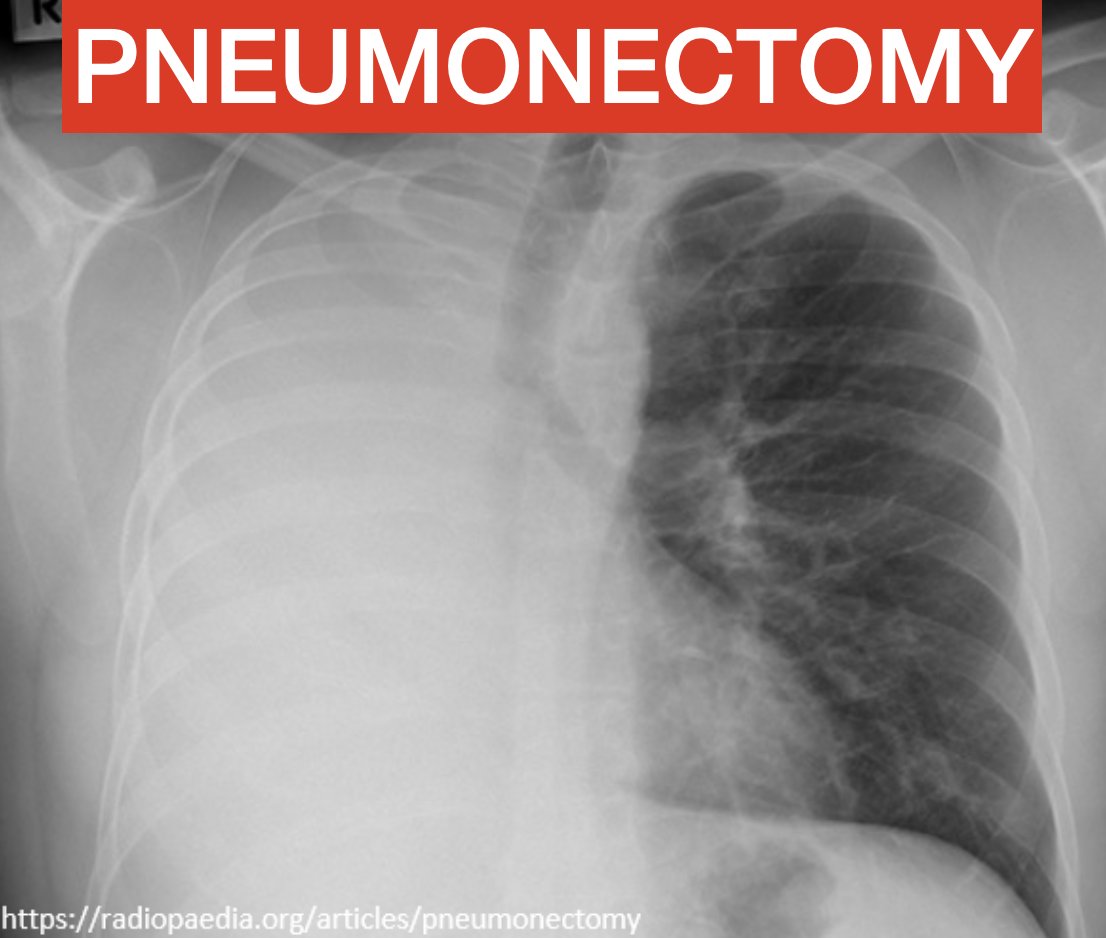 1/
Have you ever wondered how it's possible to survive with 1 lung?

We have 2 of them - you'd think that we need both. But it turns out humans can function fairly well with only a single lung.

And there's evidence that lungs can actually REGENERATE...

#tweetorial