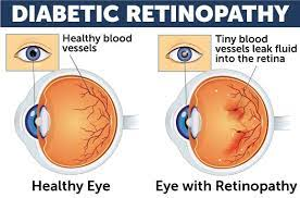 diabetes_clin's tweet photo. Submit your article on #Diabetic #eye #disease: It occurs when #retina get #damage due to #Diabetes. In which it leads to #blurred vision, #fluctuating vision, #impaired color vision, etc.
Article submission link: https://t.co/kEDtxlSBjf
Deadline for submission 20 August, 2023. https://t.co/GrmKg4uF4p