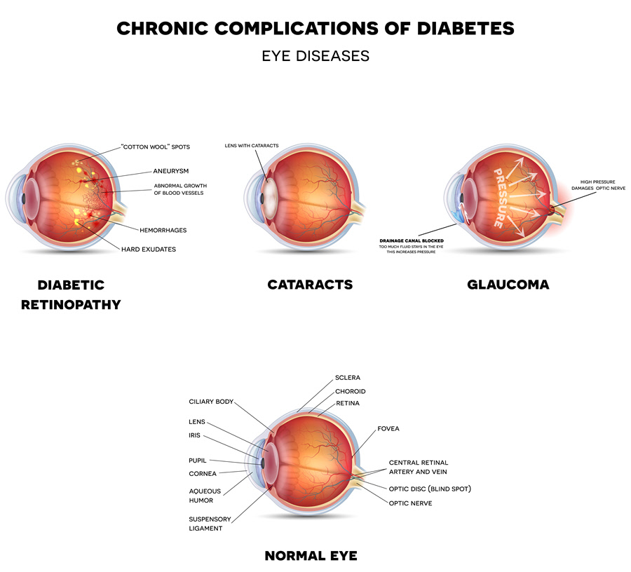 diabetes_clin's tweet photo. Submit your article on #Diabetic #eye #disease: It occurs when #retina get #damage due to #Diabetes. In which it leads to #blurred vision, #fluctuating vision, #impaired color vision, etc.
Article submission link: https://t.co/kEDtxlSBjf
Deadline for submission 20 August, 2023. https://t.co/GrmKg4uF4p