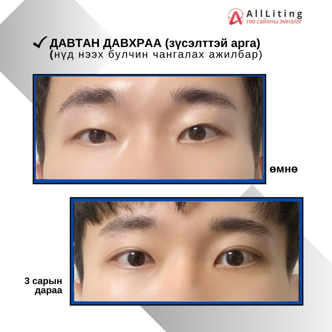 📷#ЭРЧҮҮДИЙН_НҮДНИЙ_ГОО_САЙХАН📷
хийлгэсэн ажилбар
📷ДАВТАН ДАВХРАА (зүсэлттэй арга)
(нүд нээх булчин чангалах ажилбар)
-------------------------
📷📷 ҮЗЛЭГ/ЗӨВЛӨГӨӨ үнэгүй хийж зөвхөн таньд тохирсон мэс заслын төлөвлөгөөг гаргана.
📷монгол ажилтан: 010-4931-4451