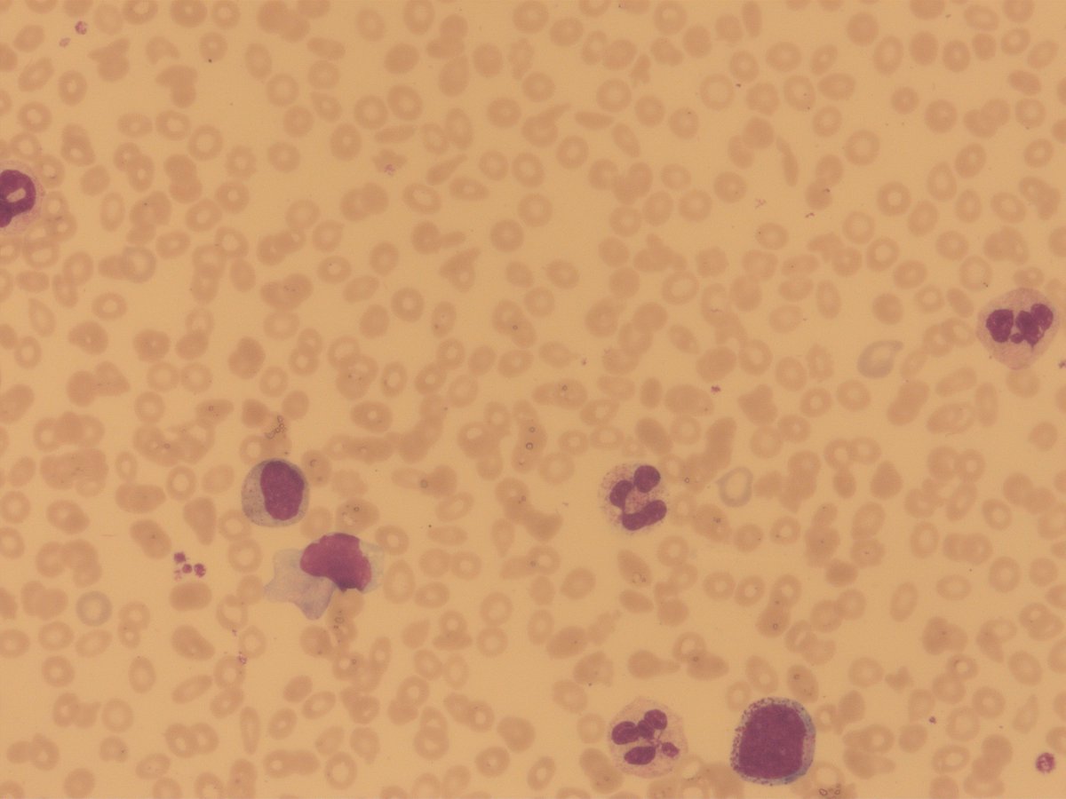 #MorphologyMonday
I am 70 years old and losing weight☹️
I can’t eat fully what’s on my plate🥴
Have fevers at night with no end in sight😭
I come to you doc for help with my plight🙏

Blood film👇👇
#hemepath #hemetwitter #blooducation #frcpath
#MedTwitter