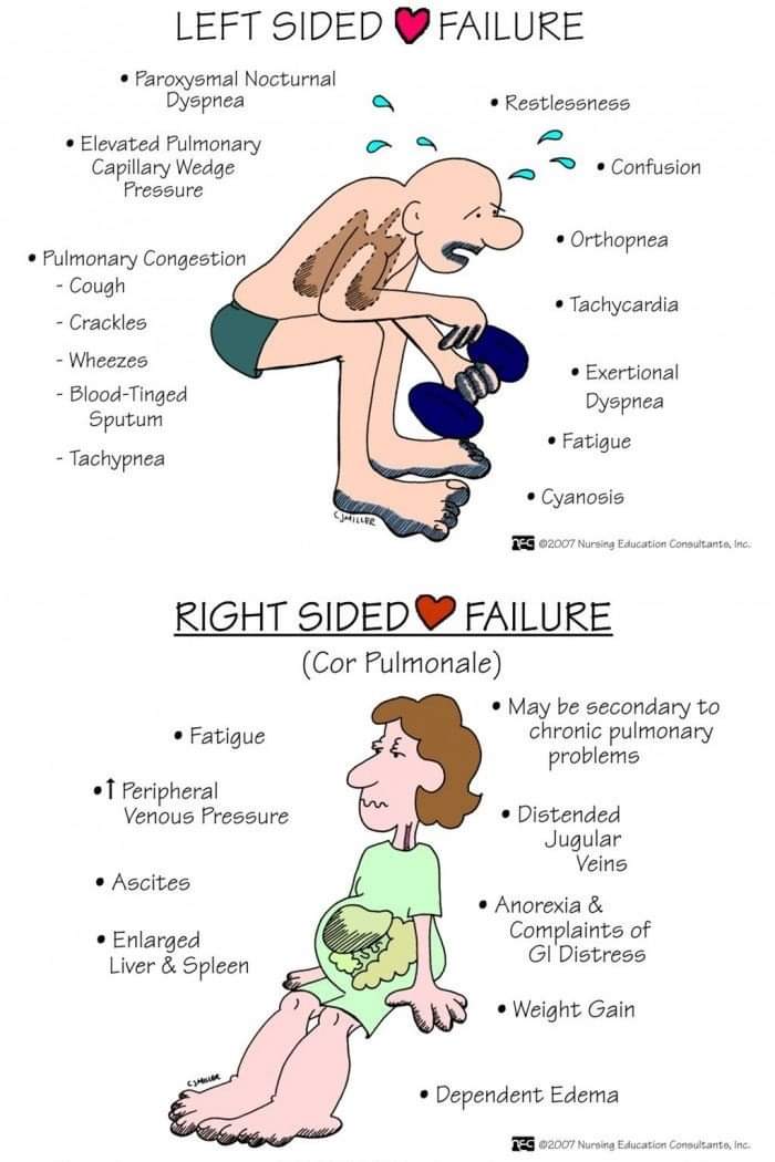walinjom's tweet photo. Left vs Right Heart failure; https://t.co/jUyKPCqA4k