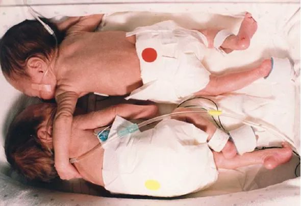 Foto-historia: El abrazo que salvó una vida. En 1995 las gemelas Kyrie y Brielle Jackson, nacieron 12 semanas antes de tiempo, cada una con un peso aproximado de 2 libras. Las enfermeras las pusieron en incubadoras separadas, se esperaba que una de las gemelas no sobreviviera.