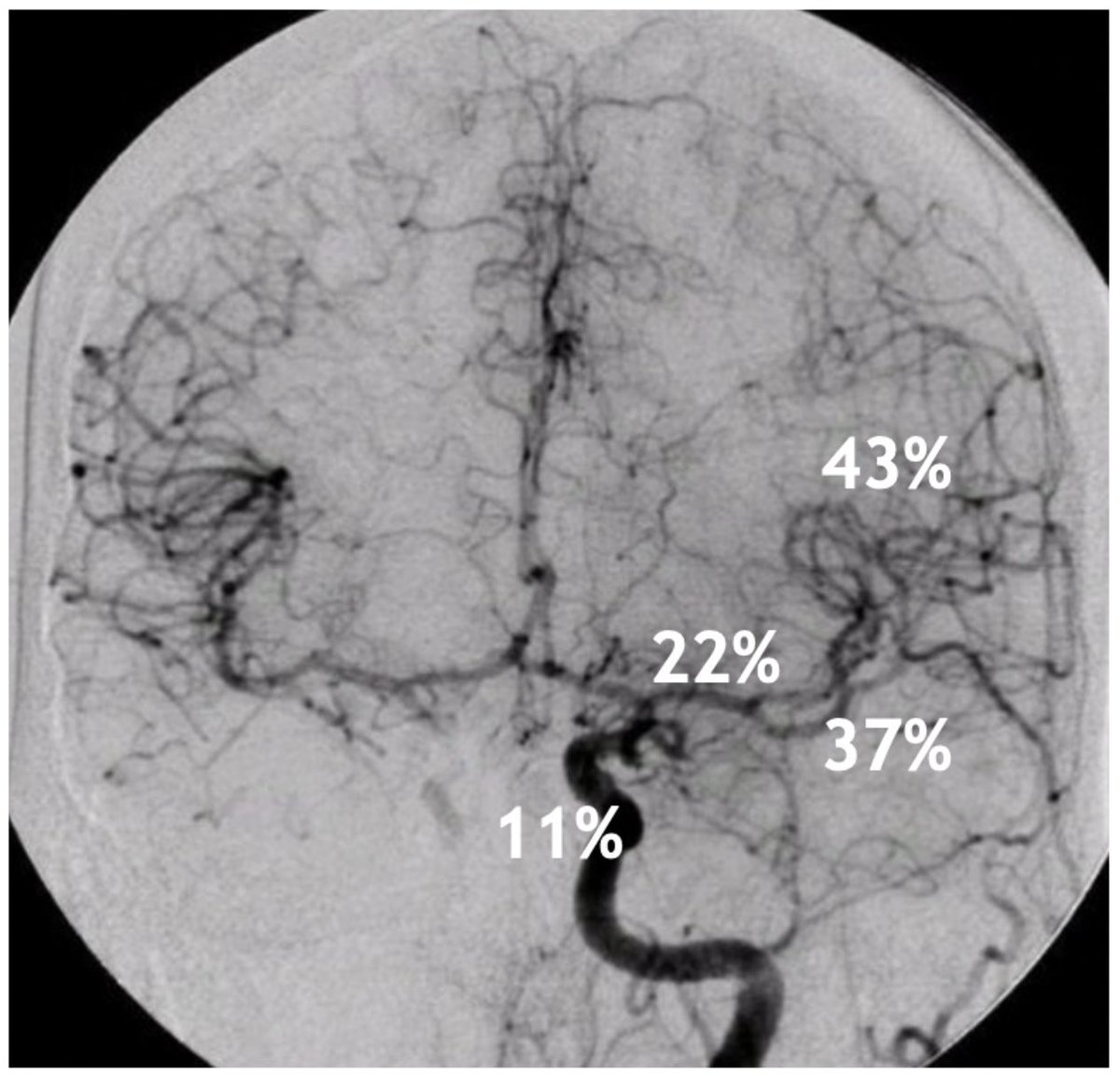 YNIScommittee's tweet photo. If you had to guess, how effective is tPA for large, medium, and distal occlusions? Below is the answer from Menon et al. 2018! #meded #JAMA #NeuroIR #NIR  @SNISinfo #stroke #thrombectomy #neurology #Neurosurgery #radiology https://t.co/mYax9ib1qJ