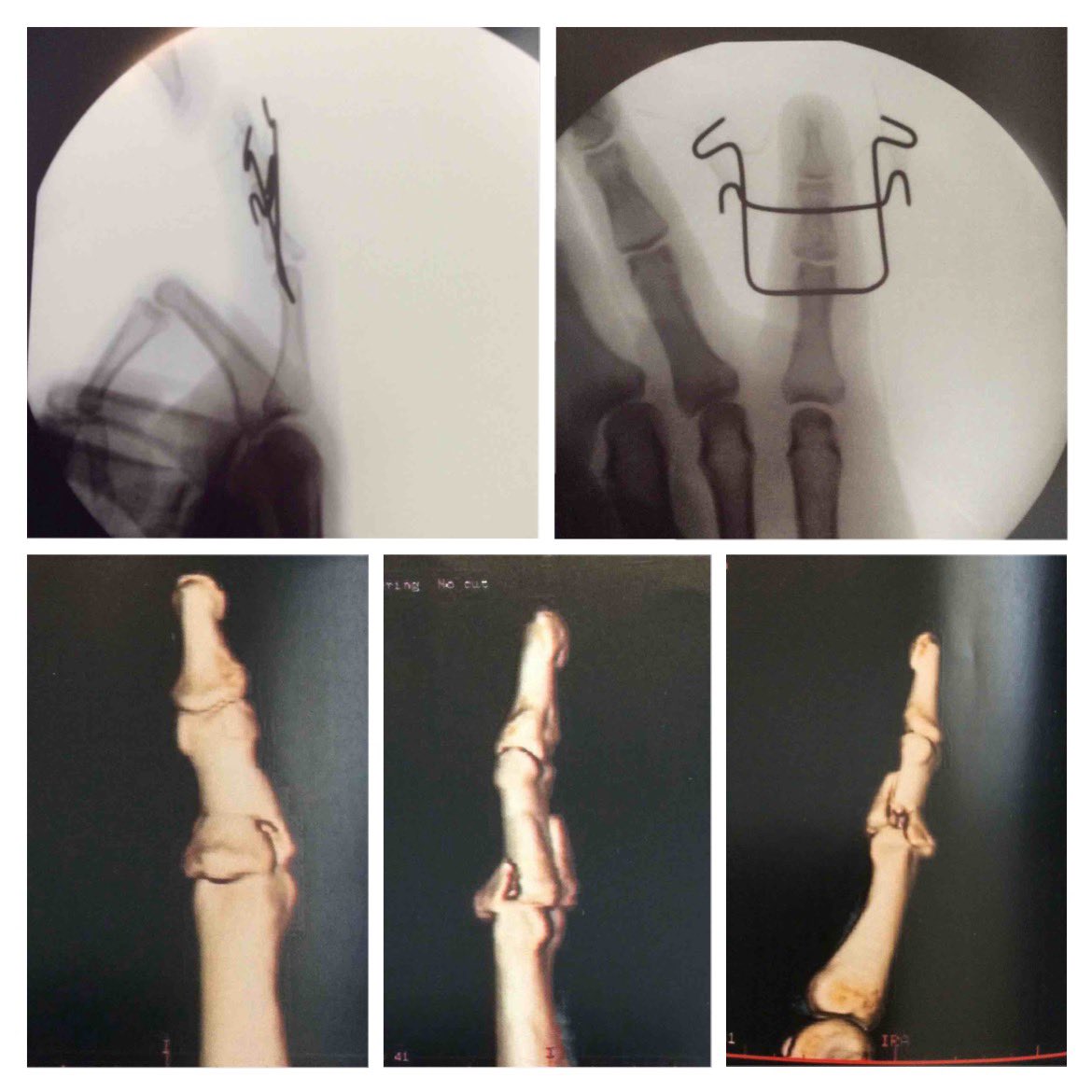 DrFPolo's tweet photo. Reconstrucciones de TAC de fractura conminuta intraarticular de base de F2 y Rx de la reducción conseguida con fijador dinámico con técnica de Suzuki.
#mano #muñeca #dedos #cirujano #cirugiadelamano #cirugiademano #madrid #drfpolo #handsurgery #handsurgeon #wrist #hand #fingers https://t.co/CGBw2xTG17