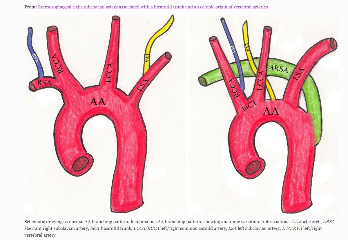 amandameyerphd's tweet photo. Saw a very interesting #AnatomicalVariation today - the right subclavian artery originating from the left common carotid and passing posterior to the oesophagus! Looked similar to the diagram on the right below from https://t.co/mpS4QVrspP https://t.co/R6l6JwDyGK