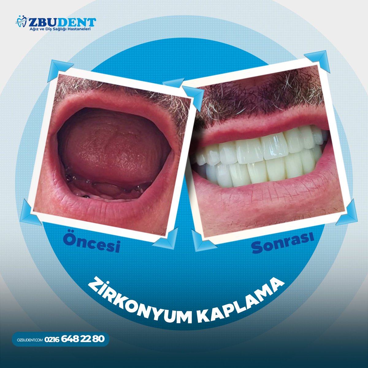 🦷 Zirkonyum Kaplama sayesinde hastamızın gülümsemesini yeniden kazanmasına yardımcı olduk.

Siz de hayalinizdeki gülümsemeye kavuşmak için bize ulaşın! 🌟

#öncevesonra #diştedavisi #gülümse #dişhastanesi #dentist #beforeandafter #uskudar #bahcelievler #sancaktepe #ümraniye