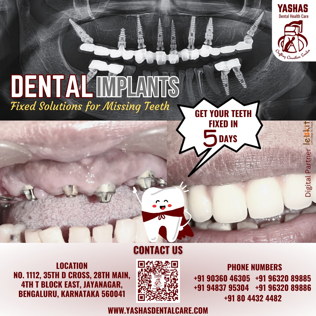 Fixed solutions for your missing teeth!

Contact YASHAS Dental Health Care for more details.

#drsheshaprasad #yashasdental #dentalclinic #bangaloredentist #jayanagar #dentalimplants #letzkit