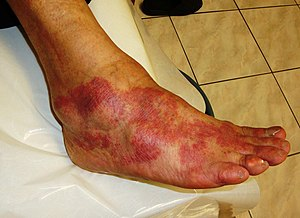 StrokeResearch2's tweet photo. #Inflammation  is part of the complex biological response of body tissues to harmful stimuli, such as pathogens, damaged cells, or irritants, and is a protective response involving immune cells, blood vessels, and molecular mediators
https://t.co/yBwh9ptUCK https://t.co/LyuRzfq6vy