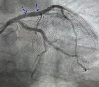 HAEQuebec's tweet image. #PhysiologyGuidedPCI with Dr. Saurabh Ranjan, MD, FACC, FSCAI ! 73-year-old male with HTN, HLD, BPH, CKD. OptoWire guided lesion assessment (dPR 0.84). 3.5 mm stent deployed and post-dilated with 3.75-4.5mm NC balloon at high pressure, achieving post-PCI dPR of 0.92!  #OptoWire