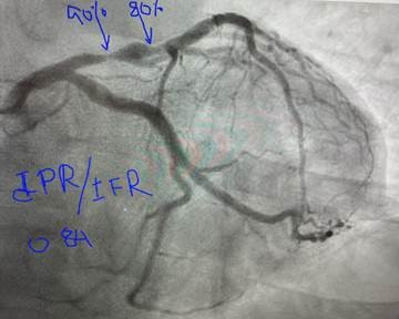 HAEQuebec's tweet image. #PhysiologyGuidedPCI with Dr. Saurabh Ranjan, MD, FACC, FSCAI ! 73-year-old male with HTN, HLD, BPH, CKD. OptoWire guided lesion assessment (dPR 0.84). 3.5 mm stent deployed and post-dilated with 3.75-4.5mm NC balloon at high pressure, achieving post-PCI dPR of 0.92!  #OptoWire