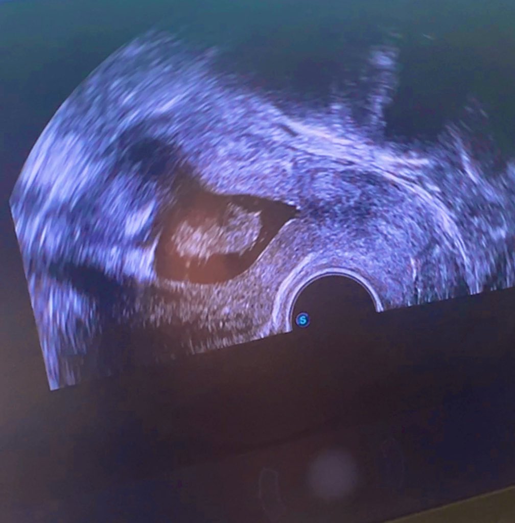dr_pariissa's tweet photo. Saline Infusion Sonohysterography (SIS)
#myoma
#SIS
#webmed
#Edmed https://t.co/glwKZVdOzg