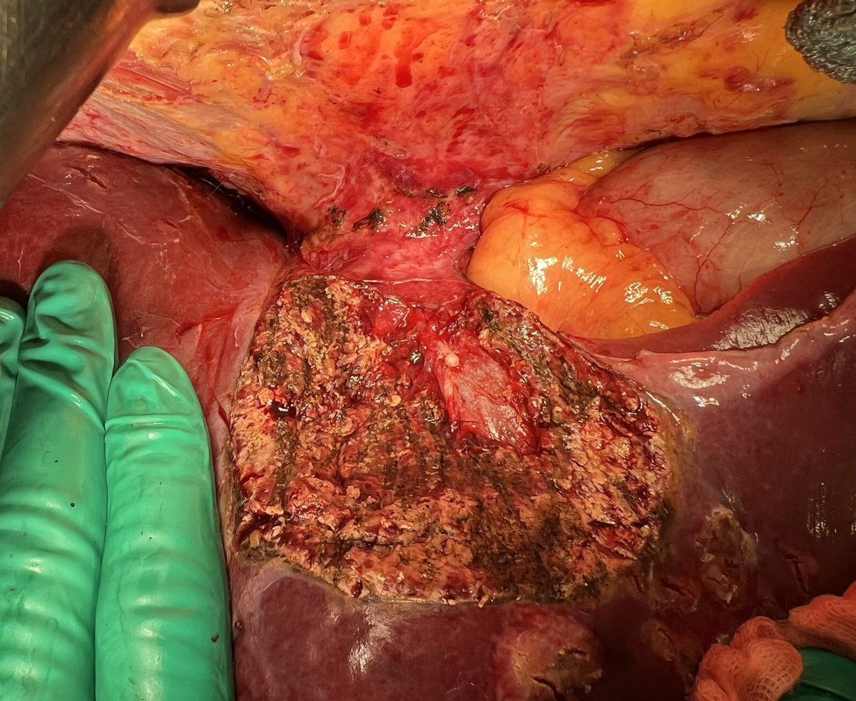 SkumsMD's tweet photo. Some venous detachment and R1-vascular today, as Prof. @TorzilliGuido have taught. 
Repeat hepatectomy for recurrent colorectal liver metastasis in S4s with contact to left hepatic vein. 
(S5,6 resection previously in 2021) https://t.co/Phn08jOcZE