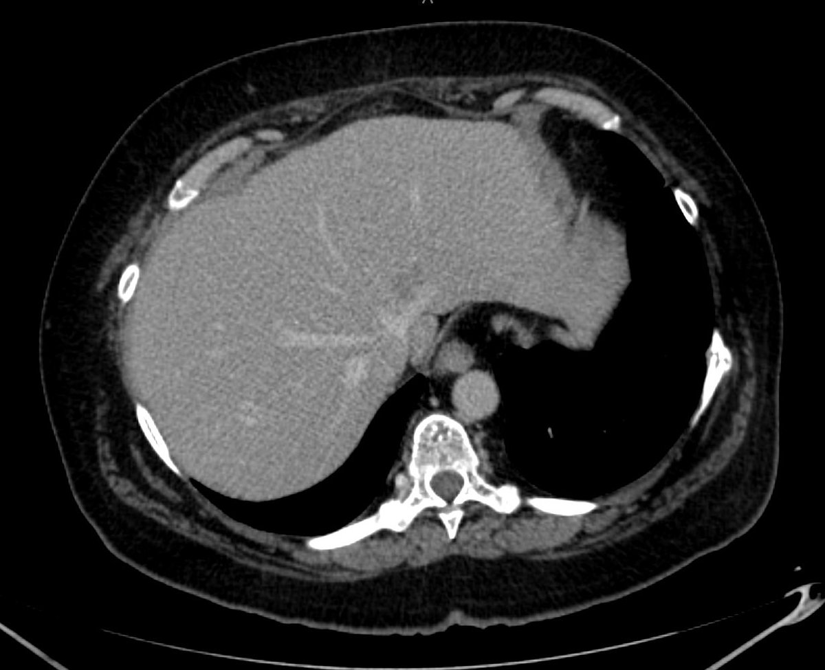 SkumsMD's tweet photo. Some venous detachment and R1-vascular today, as Prof. @TorzilliGuido have taught. 
Repeat hepatectomy for recurrent colorectal liver metastasis in S4s with contact to left hepatic vein. 
(S5,6 resection previously in 2021) https://t.co/Phn08jOcZE