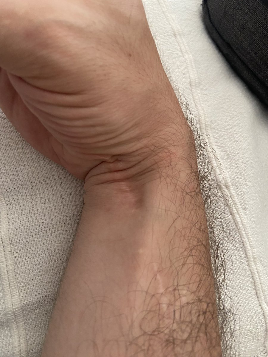 xniiiil's tweet photo. @InformaCosmos Como bien indicas en mi caso lo utilizaron quirurgicamente para poder volver a mover la mano despues de que un accidente me cortara el nervio radial! En la foto se ve como lo redirigieron para arriba! @InformaCosmos https://t.co/O4vwCzoPOH