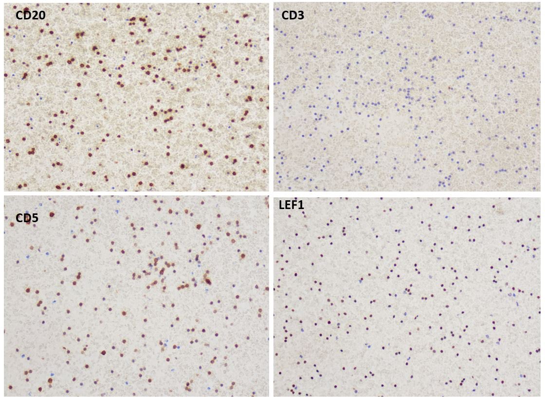 Unexpected visitor in cytology! 
Lung adenocarcinoma with Chronic Lymphocytic Leukemia (CLL) 

#pathology #hemepath #PathTwitter #cytology #surgicalpath