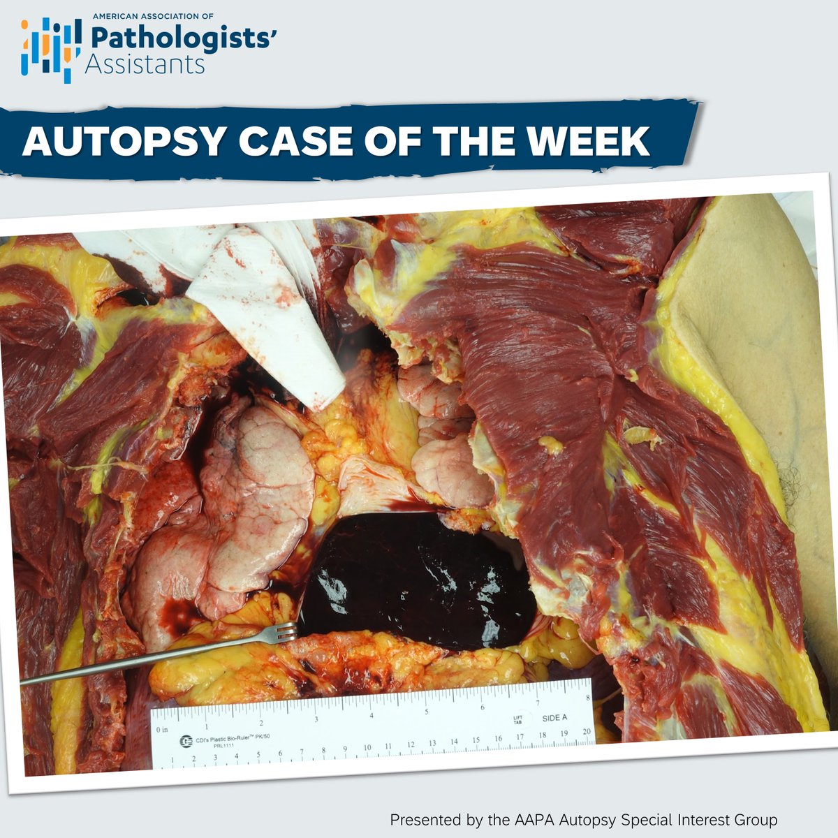 PathAssist's tweet photo. Welcome to our very first Autopsy Case of the Week! We'll be sharing case descriptions and photos to test your knowledge of autopsy pathology. Comment with your answer below - we'll be sharing the correct answer in a few days.
#pathassist #autopsypathology #autopsy #forensics https://t.co/lre6UPIHud