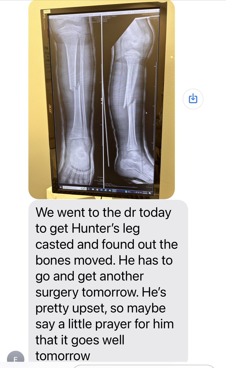 FriedScones's tweet photo. This Is a new request for broken bones prayers for Hunter. He has to have surgery tomorrow. The bones have moved. #prayersforhunter https://t.co/jpKVhS5C4X