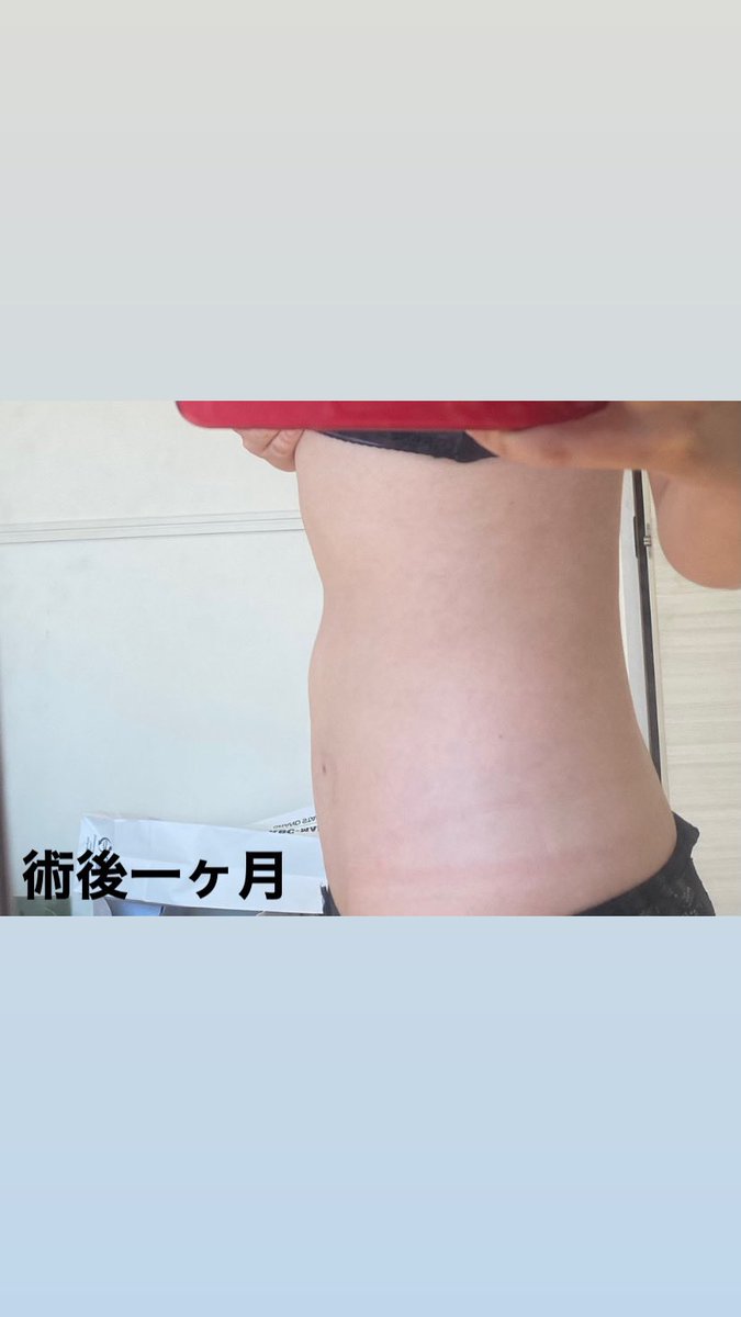 m_99893's tweet photo. エッジラインさんで脂肪吸引

一ヶ月後はこんな感じです

だいぶくびれも出てきてスッキリしてきた✨

@edgeline_jpkr https://t.co/HyOxwtVgXa