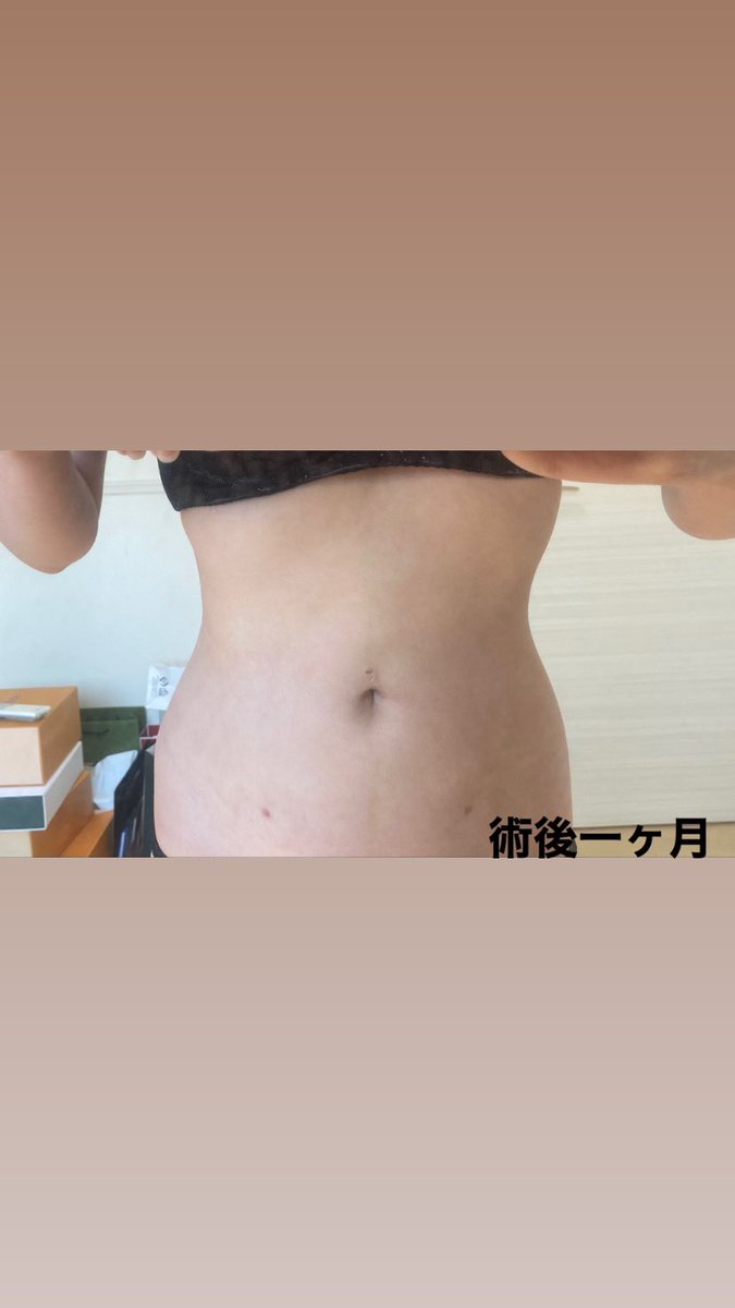 m_99893's tweet photo. エッジラインさんで脂肪吸引

一ヶ月後はこんな感じです

だいぶくびれも出てきてスッキリしてきた✨

@edgeline_jpkr https://t.co/HyOxwtVgXa