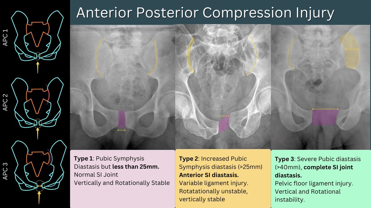 Lovely hip and pelvic injuries rPoster at #Radiopaedia2023 by @drdevrad and @samrad77! Fantastic annotations and teaching 😍 bit.ly/radiopaedia2023